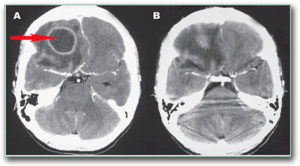 Image: CT scan of the brain. The arrow shows a pus collection in the frontal lobe of the brain