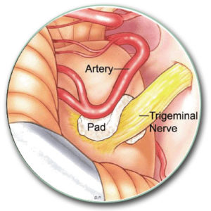 Image: The trigeminal nerve (yellow) is released from the pressure of the surrounding artery and coated with a pad of Teflon.