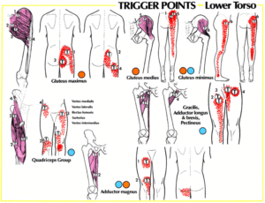 Figure: Some locations of low back pain as a result of certain pathologic processes which irritate different anatomical structures. They can occur as a result of long-term stress, such as prolonged sitting or other repetitive activities performed incorrectly.