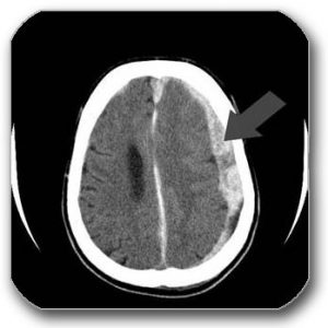 Figure: A CT scan of the brain - an arrow shows a subdural hematoma (a clot under the dura mater).