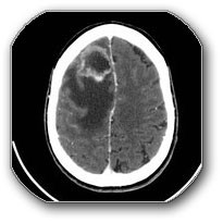 Image: A CT scan of the brain shows a metastasis in the frontal lobe of the brain, which causes greater swelling of the brain