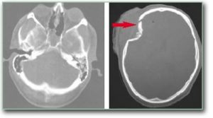 Image: A CT scan of the brain shows a skull fracture in which parts of the bone are imprinted and put pressure on the brain