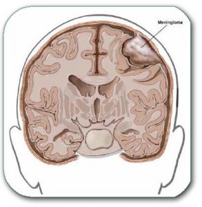 Image: A meningioma that grows from the meninges and puts pressure on the surrounding parts of the brain, without their infiltration.