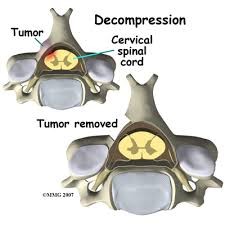 Image: A tumor in the posterior part of the vertebra (lamina) before and after surgery.