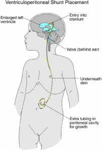 Picture: A ventriculoperitoneal shunt, by which the excess fluid from the ventricles of the brain is gradually drained into the abdominal cavity where it goes into the blood.