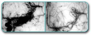 Image: Angiogram (DSA) with a tangle of blood vessels (AVM) can be seen on the left. On the right, the AVM, after embolization, is not visible. The method is performed by inserting some substances (e.g. special glue) into the tangle of blood vessels during DSA, which remain in it and prevent blood from circulating through it.