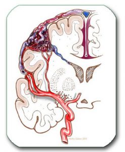 Image: AVM on the surface of the brain