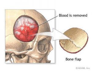 Figure: After opening the skull (craniotomy), a blood clot (epidural hematoma) is shown above the dura (the fibrous sheet covering the brain), which is removed and then the bleeding is stopped.