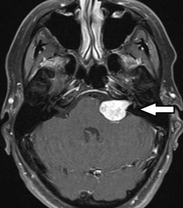 Figure: An MRI scan of the brain shows a pontocerebellar schwannoma (acoustic neuroma)