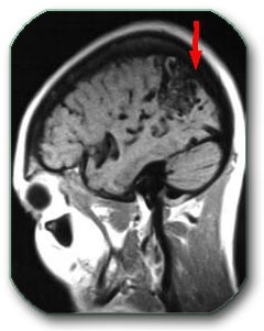 Image: An MRI scan of the brain shows the AVM