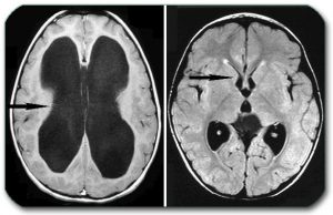 Image: An MRI scan on the left shows very enlarged ventricles of the brain. (Senile dementia may look similar). The image on the right shows what normal ventricles look like (arrows show chambers).