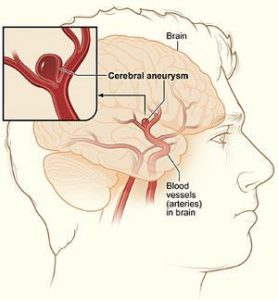 Aneurysm (sac dilation) of a brain artery