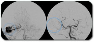 Picture: AVM can be seen on the left (shown with arrows). The same patient is seen on the right 3 years after stereotactic radiation (Gamma knife)