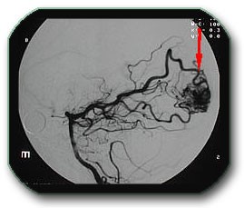 Image: Angiography shows a tangle of blood vessels (AVM)