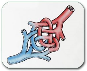 Image: Arteriovenous malformation. The red part is arterial, and the blue part is the venous part of the malformation.