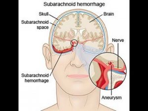 Bleeding from an aneurysm into the subarachnoid space