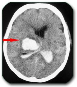 Image: Bleeding in deep brain structures, and in brain ventricles