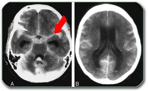 CT scan of the brain – the arrow shows blood in the subarachnoid space (on the CT scan fresh blood is white in color)