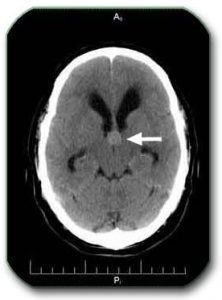 Image: CT scan of the brain. The arrow shows a colloid cyst that prevents the flow of cerebrospinal fluid and causes the ventricles to expand (hydrocephalus). When it is removed, it will probably eliminate hydrocephalus without additional treatment