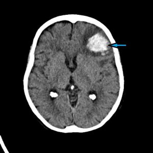 Image: CT scan of the brain – the blue arrow shows bleeding in the frontal lobe of the brain (hematoma) resulting from an AVM rupture.