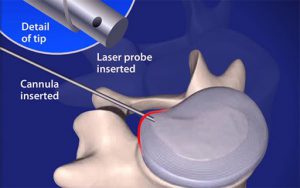 Image: Cannula inserted in a disc with disc protrusion and intact posterior ligaments. Part of the disc inside are shrunk by laser, allowing the intact posterior ligament to push the protruded part backwards away from nerve root.