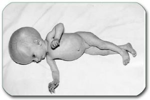 Picture: Child with hydrocephalus - the head is enlarged, the veins on the head are pronounced, and the child does not progress in development.