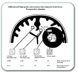 Figure: Cross-section of two hemispheres of the cerebrum. In the right there is a large malignant glioma (about 4 centimeters in diameter). In this case, the tumor cells have already penetrated into the wider environment by infiltration (even into the opposite hemisphere).