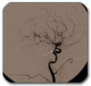  DSA (angiography) shows the arteries of the brain and the aneurysm is marked with an arrow