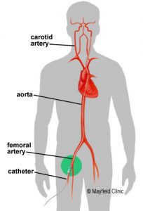 Digital subtraction angiography (DSA) - Introduction of a catheter into the artery of the leg from where it passes through the arteries of the abdomen, chest and neck into the arteries of the brain. Then, through this catheter, brain arteries are filled with contrast (iodine contrast) and recorded.