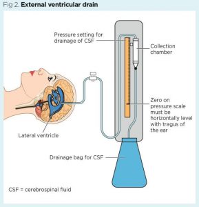 Figure: EVD- excessive CSF is continuously evacuated out of the brain into a sterile sac for days. This prevents accumulation of water inside brain ventricles and increasing the pressure on the brain (hydrocephalus).