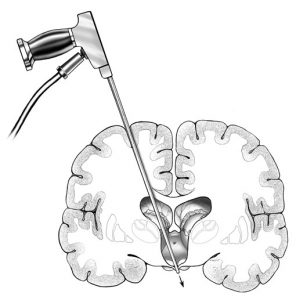 Figure: Endoscopic intervention opens the floor of the third ventricle. It can be done if there is an obstacle to the outflow of cerebrospinal fluid between the brain ventricles (mostly between the 3rd ETV and 4th ventricle), to bypass this obstacle.