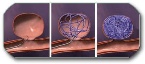 Filling an aneurysm with wire (coiling the aneurysm)