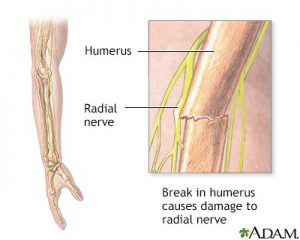 Figure: Fracture of the upper arm bone, fragments of which injure the radial nerve.