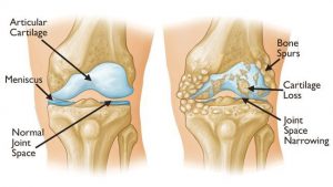 Image: Gonarthritis