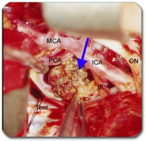 Image: Intraoperative image in which a blue arrow shows a cavernoma