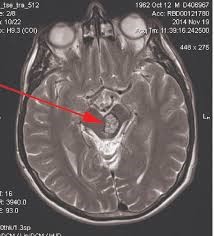 Image: MR image of the brain in which a red arrow shows a cavern in the area of ​​the brain stem.