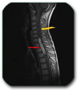 Image: MR image of the spine shows a tumor of the spinal cord (ependymoma - red arrow) which causes the appearance of cysts inside the spinal cord above and below itself (yellow arrow).