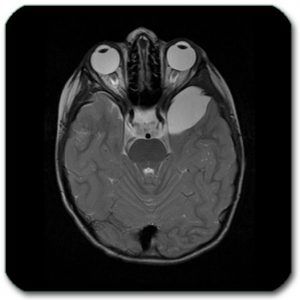 Images: MRI and CT scans of the brain show a temporal cyst that does not require any treatment