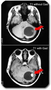 An MRI scan of the cerebellum shows a cystic formation with a nodule (hemangioblastoma) in the wall. The treatment is operative. In the vast majority of cases, the cure is complete without any operative complications.