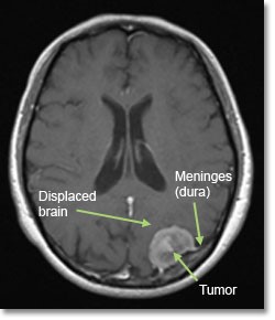 Magnetic resonance imaging of the brain showing meningioma of the occipital region