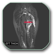 Image: Magnetic resonance imaging of thick flesh and thighs. The arrow shows plexiform neurinoma.