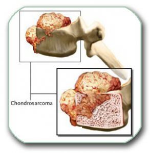 Picture: Malignant tumor (chondrosarcoma) of the vertebral body