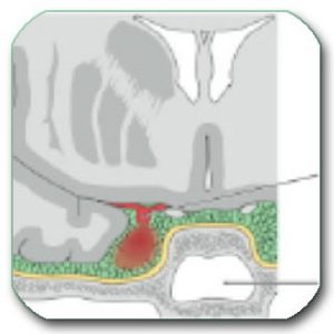 Most aneurysms are in the large arteries below the lower surface (base) of the brain