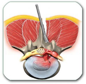 Figure: Penetration of the grasping instrument, with or without removal of part of the posterior wall of the spinal canal, to enter the canal and remove the part of the disc that exerts pressure on the nerve root.Endoscopic disc removal is indicated in most disc herniations. It enables the remova