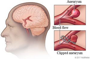 Placing a clip on the neck of a ruptured aneurysm