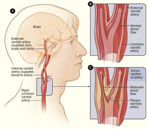 Plaque at the fork of the carotid artery