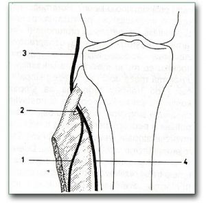 Figure: Pressure on the peroneal nerve in the area below the knee- The knee joint is shown with 3 marking the peroneal nerve, and 2 marking the muscle that most often exerts pressure on the nerve