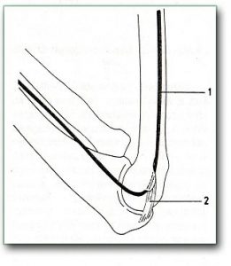 Figure: Pressure on the ulnar nerve in the elbow - 1) The ulnar nerve, 2) The connective tissue that puts pressure on the nerve