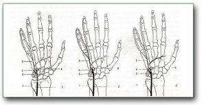 Figure: Pressure on the ulnar nerve in ​​the root of the hand