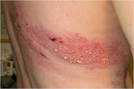 Skin changes in herpes zoster infection